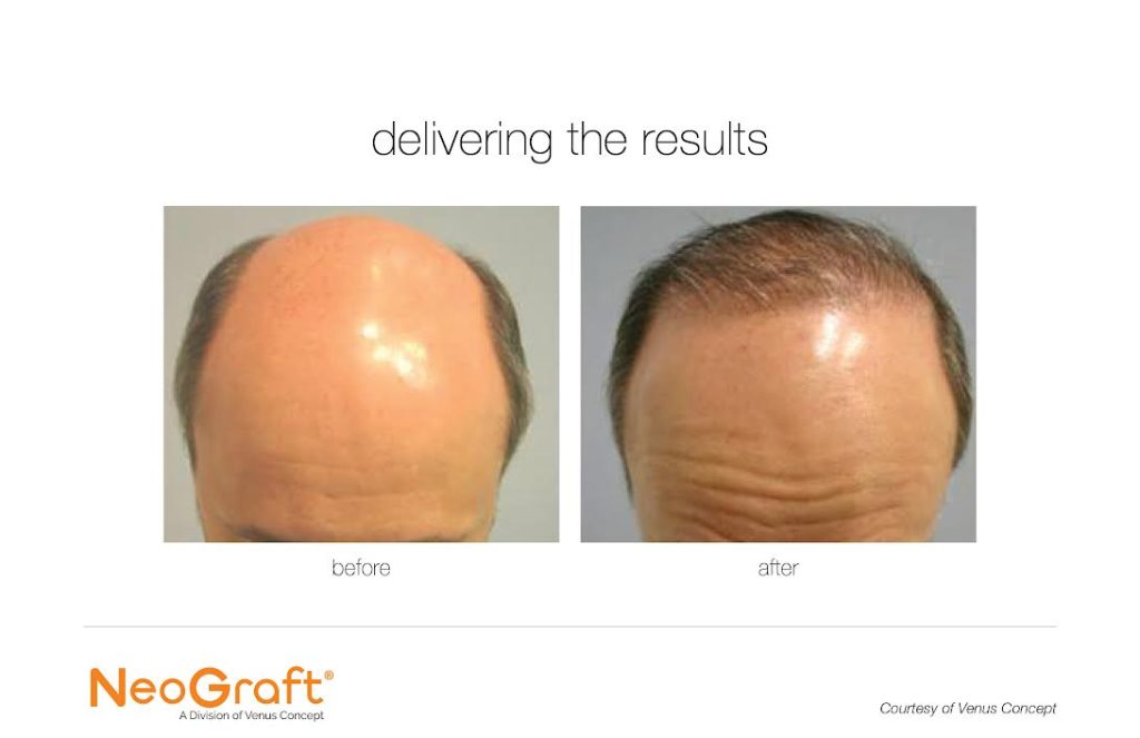 Neograft for Hair Restoration