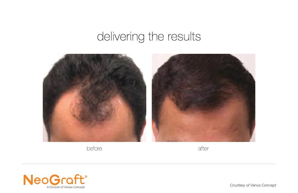 Neograft for Hair Restoration