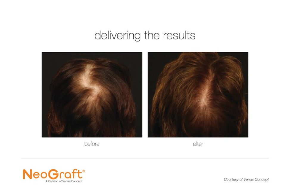 Neograft for Hair Restoration